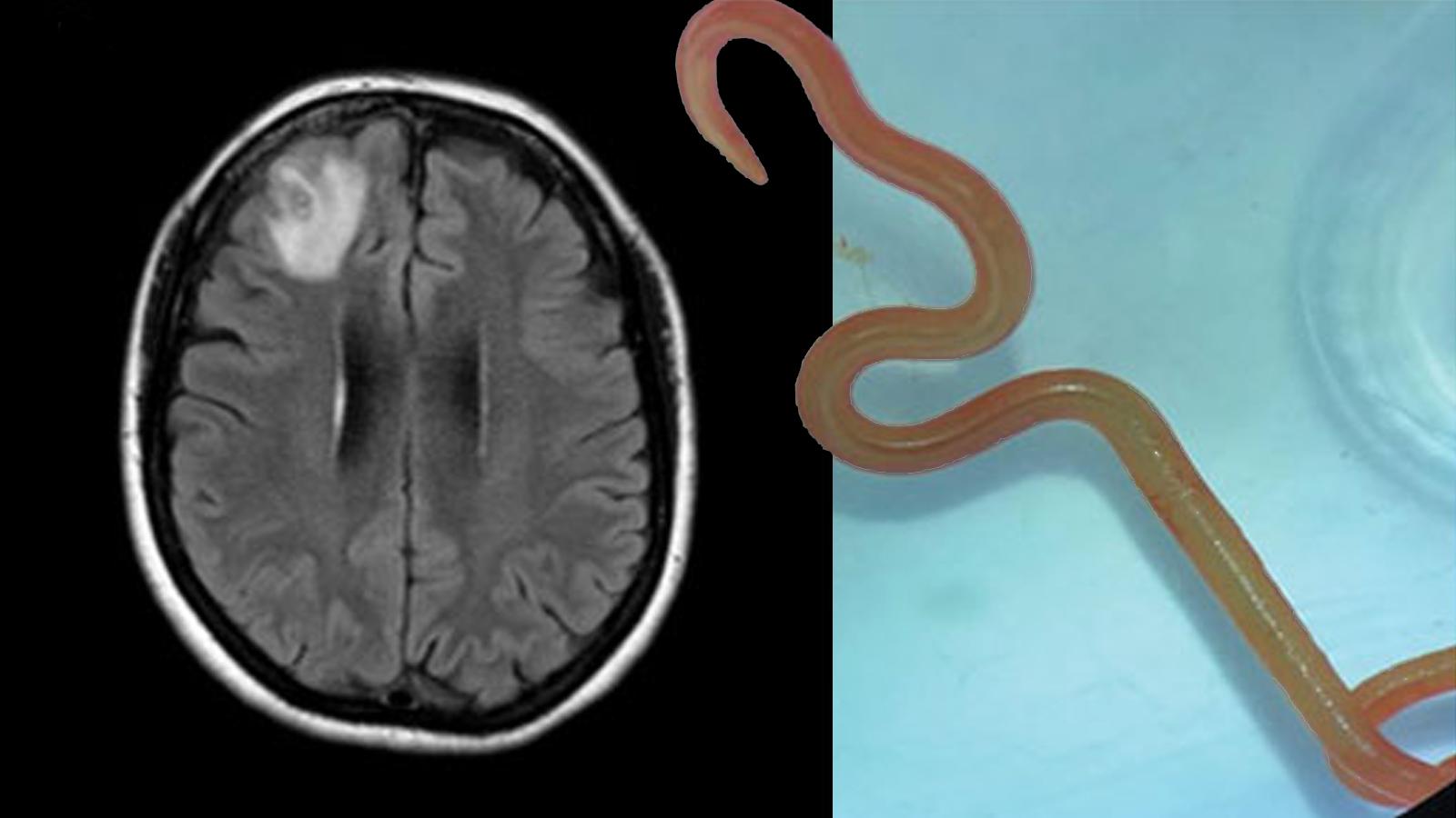 Ζωντανό σκουλήκι βρέθηκε σε εγκέφαλο γυναίκας και ούτε οι γιατροί το πίστευαν